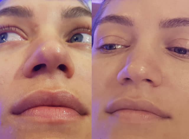 ג'ני צ'רוואני. התפחת שפתיים מד אופ. לפני ואחרי. צילום: יח״צ