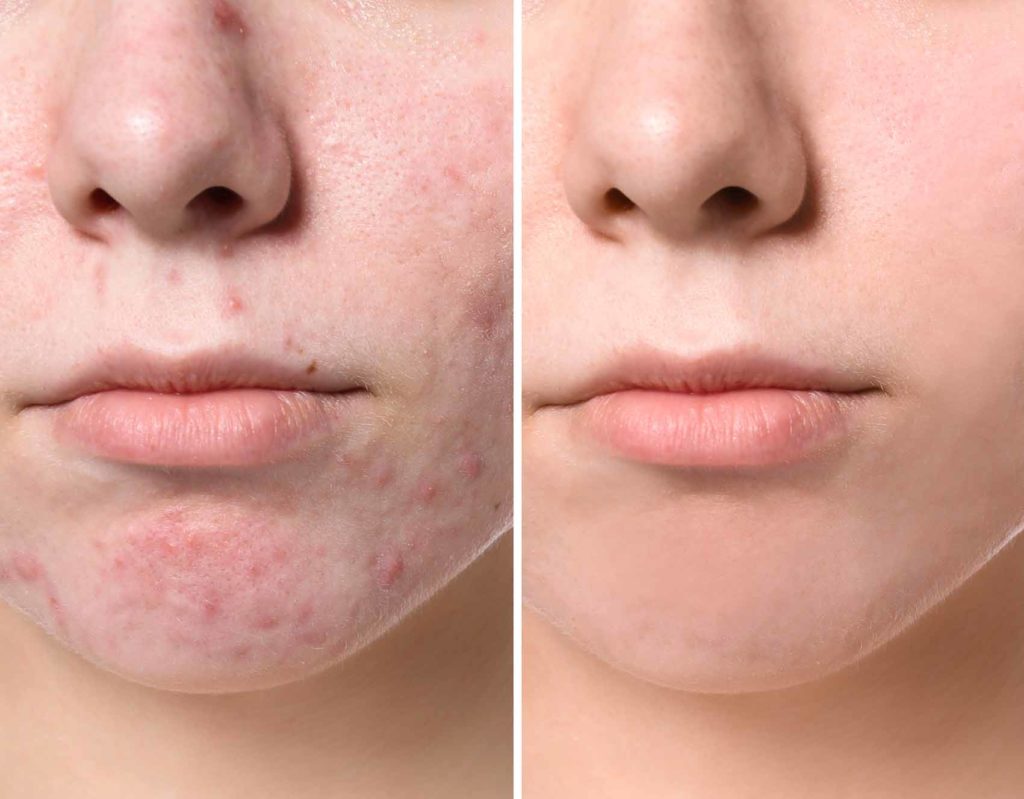 Young,Woman,Before,And,After,Acne,Treatment,,Closeup.,Skin,Care - 2