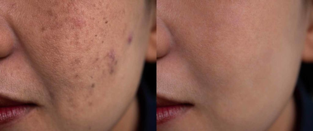 Image,Before,And,After,Spot,Melasma,Pigmentation,Skin,Facial,Treatment - 1