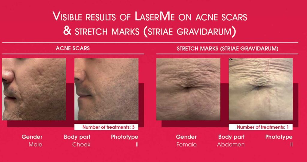 לפני ואחרי טיפול LASERME -1